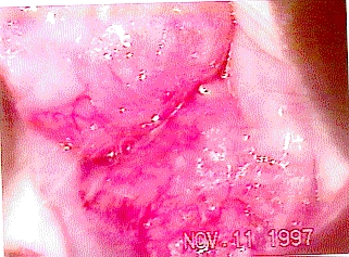 infeccin uterina