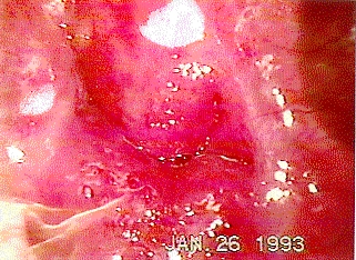 disfuncin uterina crnica